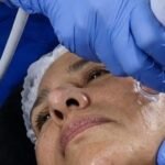 Hidrodermoabrasión facial en cusco
